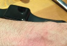 Apple грозит суд из-за аллергии на ремешки от умных часов